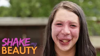 I Won't Cover My Birthmark For Bullies Anymore | SHAKE MY BEAUTY