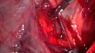 The Use of Alexis Wound Protector/Retractor after laparoscopic hysterectomy