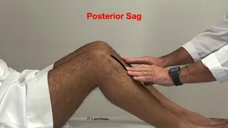 Posterior sag and posterior draw