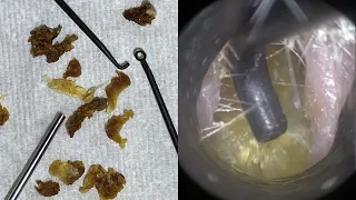 115 - Masses of Hardened Dead Skin Extracted from Narrow Ear with WAXscope®️