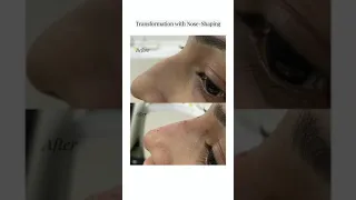 Nose transformation at Laser Treat! ✨