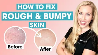 How To Fix Rough and Bumpy Skin | Keratosis Pilaris Affordable Skincare Routine