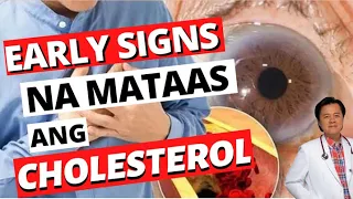 Early Signs na Mataas ang Cholesterol - By Doc Willie Ong