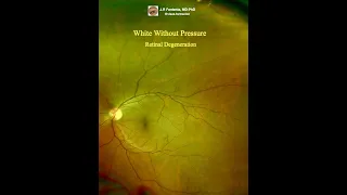 White Without Pressure. Peripheral Retinal Degenerations.