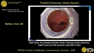 Per oral pyloromyotomy (POP) for delayed gastric emptying after sleeve gastrectomy