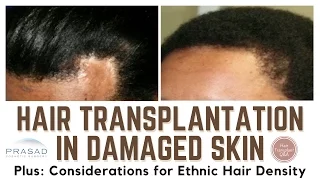 Hair Transplant Considerations for Traction Alopecia, Damaged Skin, and Ethnic Hair Density