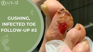 Gushing Infected Toe Follow-Up #2