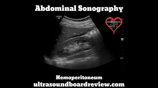 Hemoperitoneum