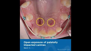 The gradual process of realigning impacted canines through orthodontic treatment by Dr Kasem Atassi