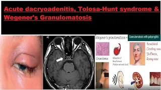 Acute dacryoadenitis, Tolosa–Hunt syndrome & Wegener's Granulomatosis #kanskiseries #2022 #2023