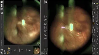 Navigated peripheral retinopexy (Navilas) Навигационная отграничительная лазеркоагуляция