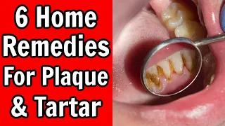 6 Home Remedies For Plaque and Tartar Build Up