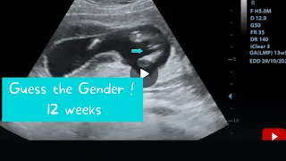 12 weeks ultrasound | Guess the gender !