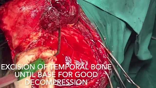 Decompressive Craniectomy | Public information video