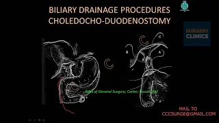 CCC Advanced - CBD Stones - Decision Making & Management by Sanjay De Bakshi.