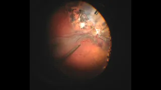 25g Vitrectomy and Tractional Retinal Detachment Repair secondary to Coats Disease