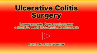 Ulcerative Colitis surgery