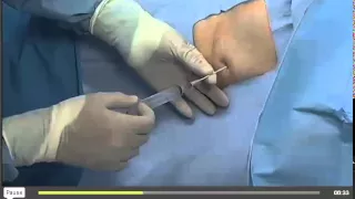 PleurX catheter placment