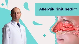 Allergik rinit nədir? Hansı Əlamətləri var?