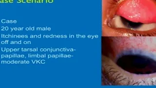 AIOC2018 - IC95 - Topic - Ocular Allergy - An Enigma for physicians medical management