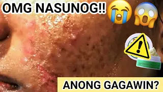 NASUNOG ANG MUKHA SA REJUVENATING SET?!! ANONG DAPAT GAWIN?