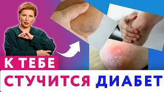 Почему ЛОКТИ СУХИЕ и шершавые // Причины сухих локтей