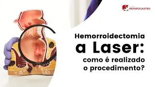 Hemorroidectomia a Laser: como é realizado o procedimento? | Clínica Hepatogastro