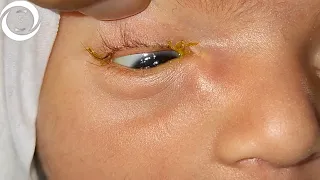 Congenital Lacrimal Encysted Mucocele