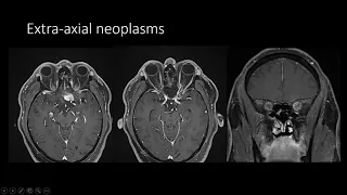 Imaging Extra axial tumor