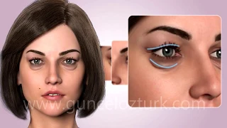 Cosmetic Eye Surgery - Upper and Lower Eyelid Aesthetic - Blepharoplasty. Guncel Ozturk, MD - #DRGO