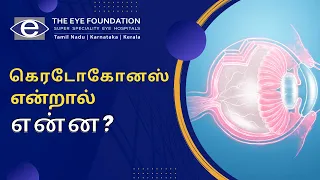 கெரடோகோனஸ் என்றால் என்ன என்பதை டாக்டர் அபிராமசுந்தரியிடம் இருந்து தெரிந்து கொள்ளுங்கள்