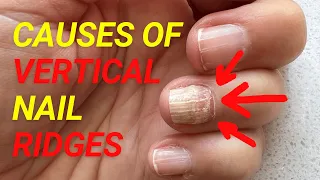 The TRUE Causes of VERTICAL RIDGES On Your Nails