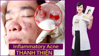 Inflammatory Acne |Điều trị mụn hiệu quả số 1 TPHCM| |Hiền Vân Spa |Thanh Thiện| Mụn viêm tụ máu|542