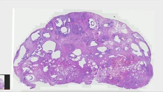 Pulmonary Pathology High Yield Review: UIP