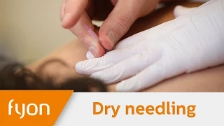 Dry Needling behandeling tegen chronische pijn en myofasciale problemen - Fyon