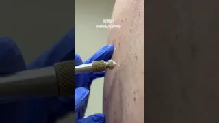 #shorts How Dermatologists Remove Skin Growths with Liquid Nitrogen