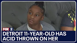 Detroit 11-year-old has acid thrown on her