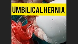 Hernia in calf । symptoms, diagnosis & treatment by surgery। Dr.Umar khan