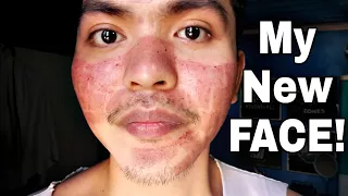 My Fractional CO2 Laser Treatment Experience (TAGALOG)