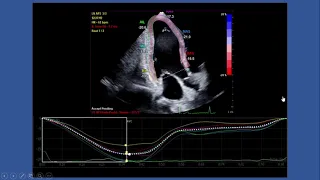 Strain Echocardiography by speckle tracking and tissue Doppler -Part I:technique