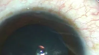 Intravitreal injection of Anti VEGF : the best way to protect optic nerve, lens and cornea..