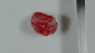 Biópsia Excisional de Grauloma Piogênico