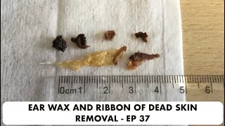 RIBBON OF DEAD SKIN AND EAR WAX REMOVAL - EP 37