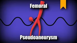 Femoral Pseudoaneurysm