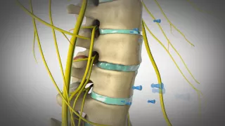 Orlando Chiropractic - Disc Injuries, custom 3D animation