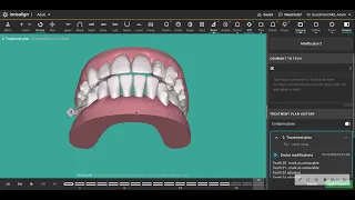 Orthodontic alignment in adults could actually worsen the bite instead of improve it.