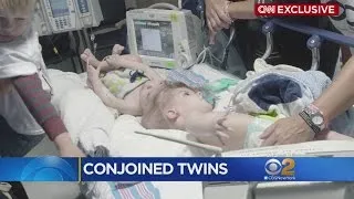 Separating Conjoined Twins