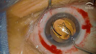 Cirugía de Catarata con Láser Femtosegundo + Implantación de Lente Intraocular PanOptix Tórico