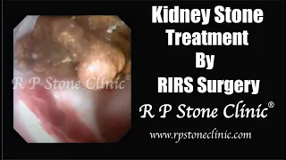 Kidney Stone treated by RIRS Surgery
