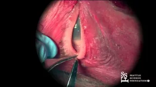 Canthotomy/Cantholysis Demonstration by AJ Amadi, MD